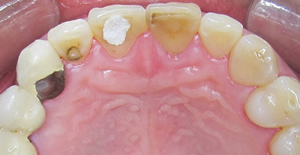 根管治疗对我们的大脑有害吗?--广州德伦口腔