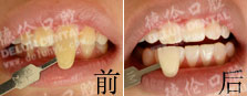 黄牙美白案例