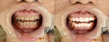 皓齿美白 遗传性色素牙案例