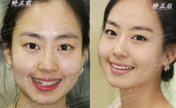 正畸案例:牙齿咬合不齐,女神也难进豪门