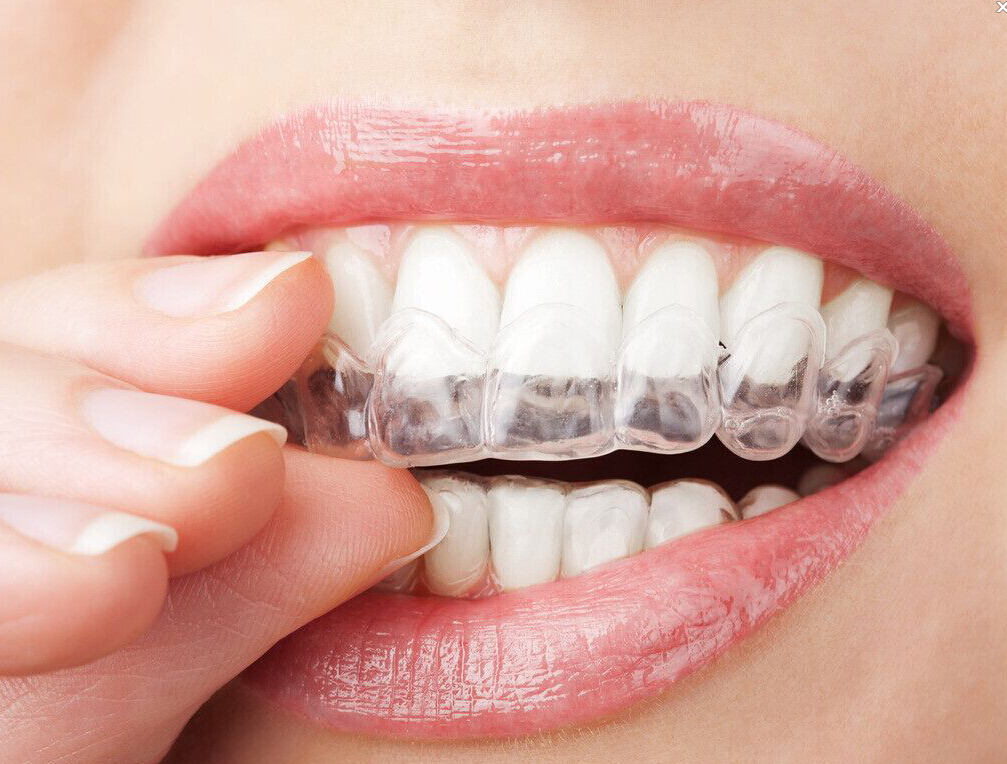 隐形矫正牙套“试戴汇”_广州德伦口腔
