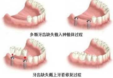 广州多颗牙种植术后该怎么护理--广州德伦口腔