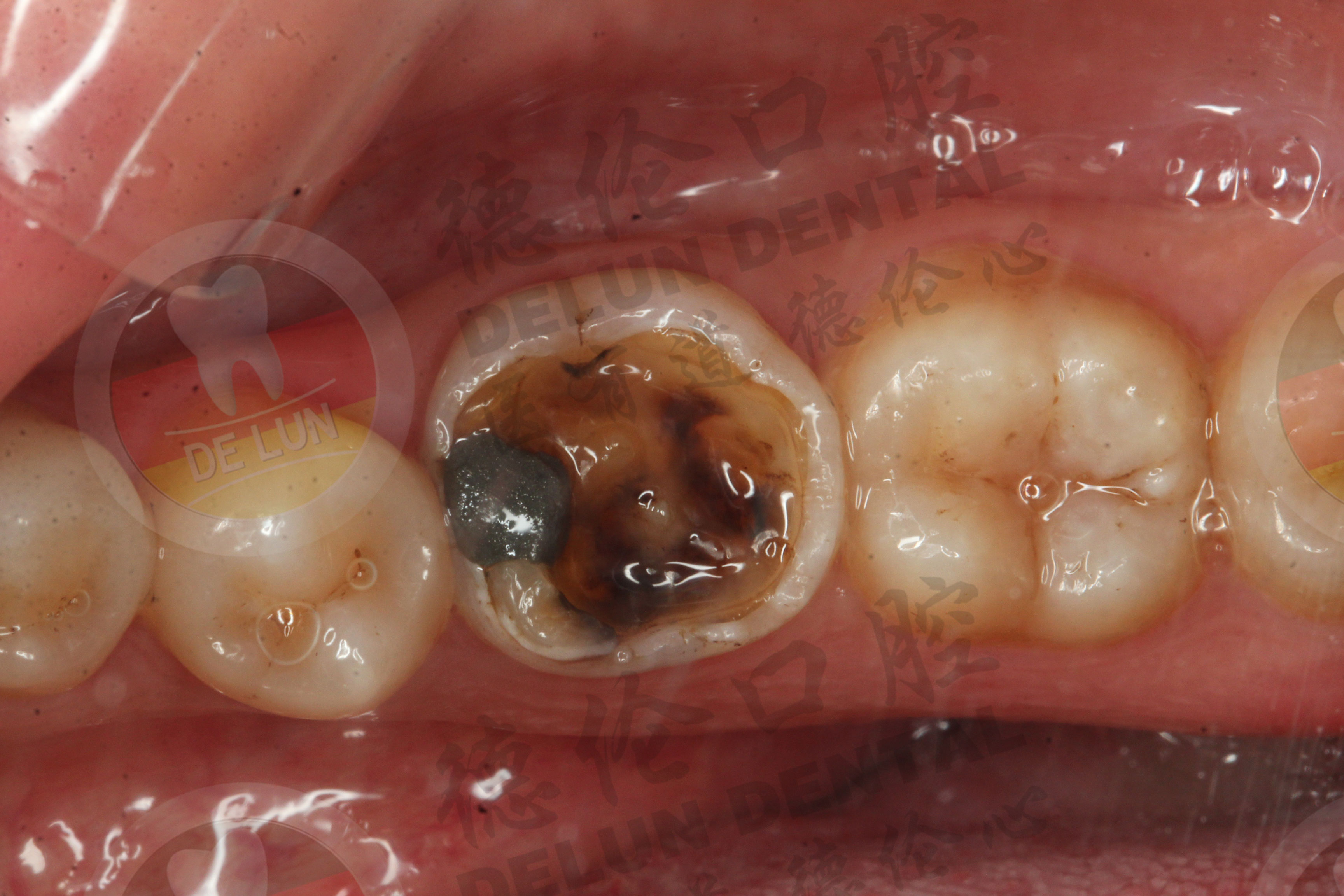 蛀牙的龋坏范围到牙龈下了，手术翻瓣，树脂充填补牙 - 知乎