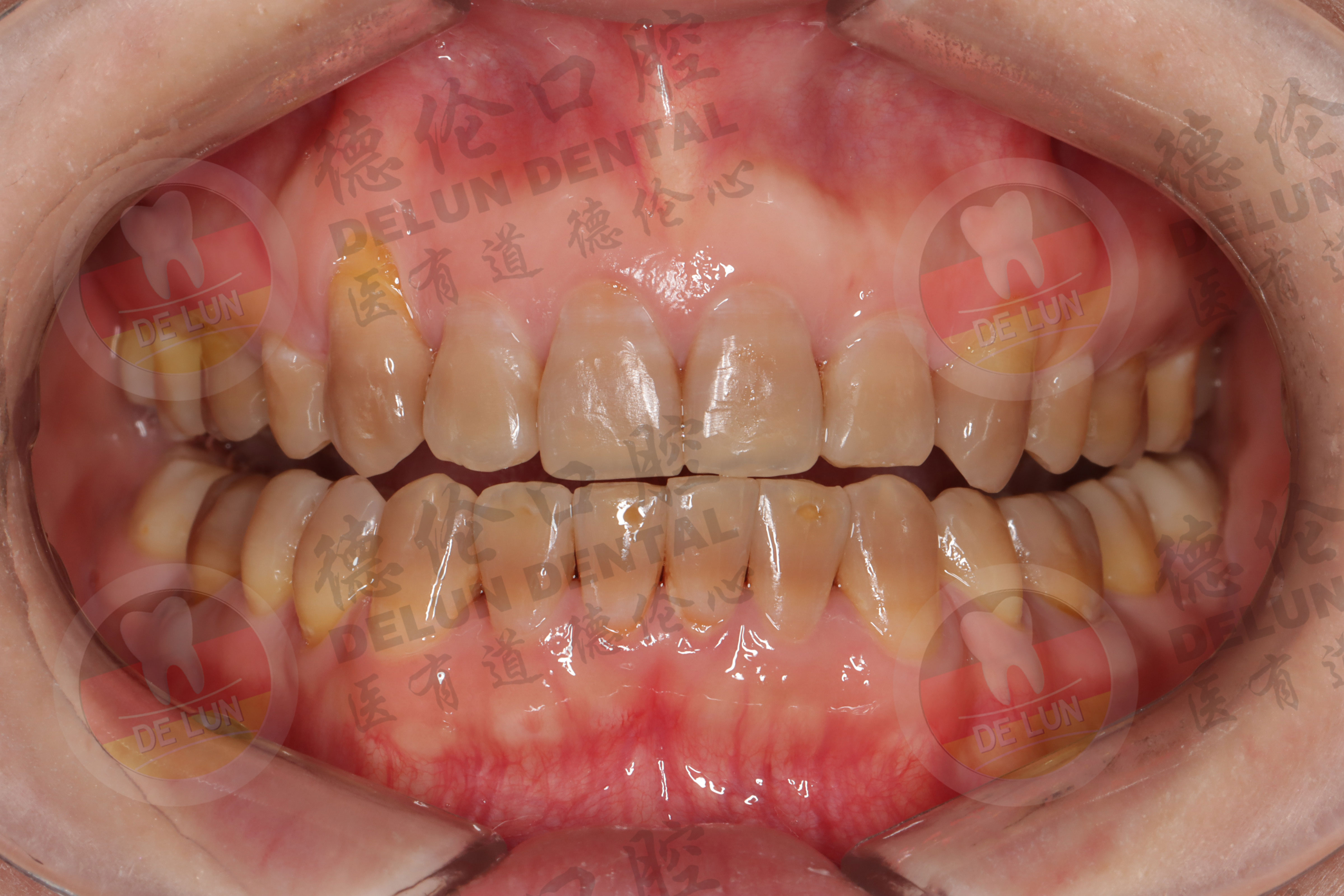 三5.牙本质暴露引起牙齿敏感酸疼