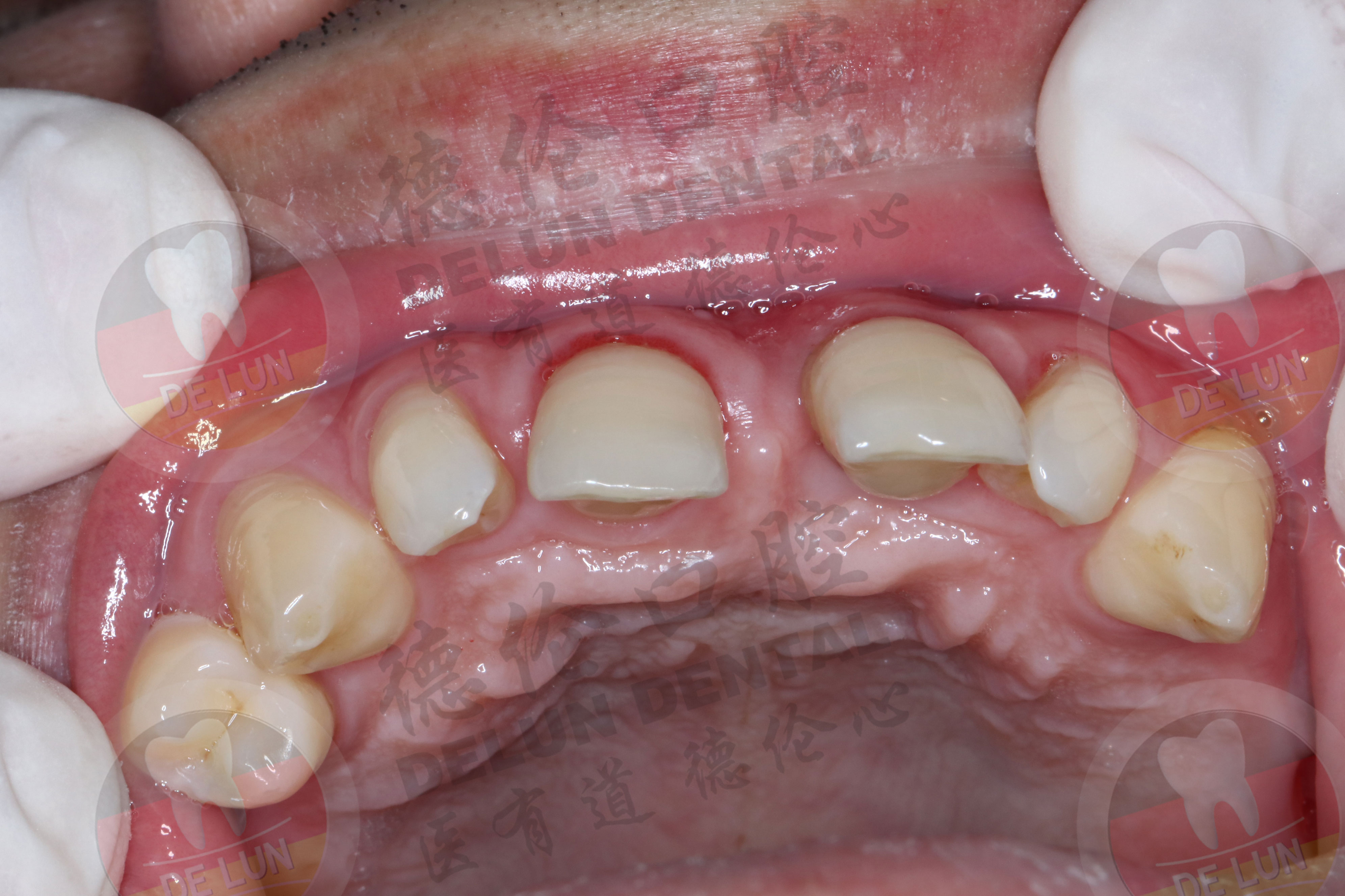牙龈出血该如何预防？_新余傅氏口腔--新余牙科-新余口腔烤瓷牙,新余口腔矫正,新余口腔