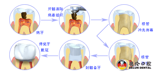 镍钛根管治疗术治疗牙齿病变更有效_广州德伦