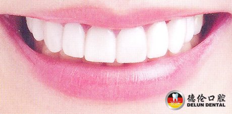 牙齿矫正有没有年龄限制呢--广州德伦口腔