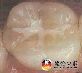 儿童牙齿的保护外衣 窝沟封闭