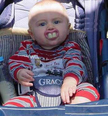 儿童龅牙怎么矫正_广州德伦口腔