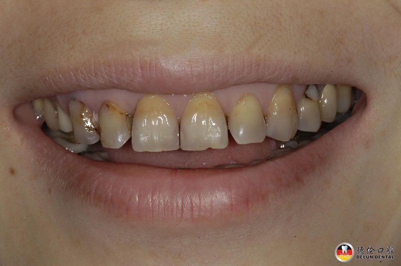 四环素牙的原因及治疗