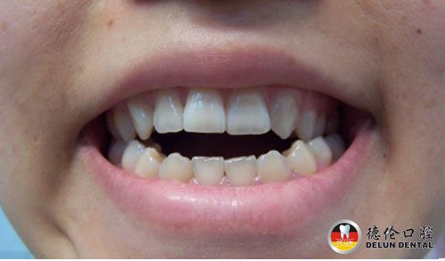 什么是骨源型地包天--广州德伦口腔医院