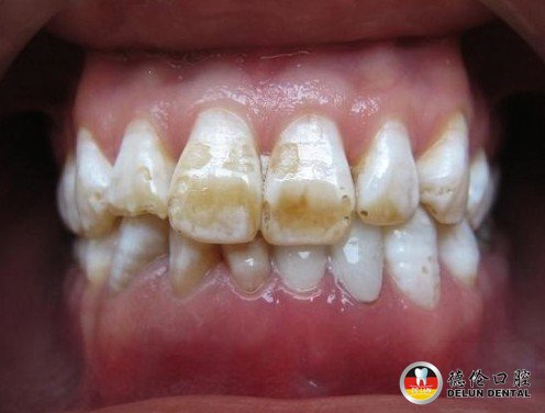 氟斑牙的分类--广州德伦口腔