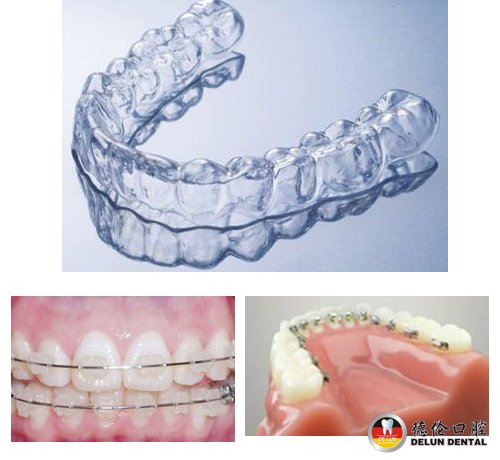 儿童牙齿矫正器有哪些