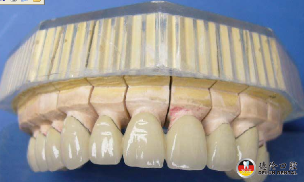 装烤瓷牙装出一身疾病--广州德伦口腔