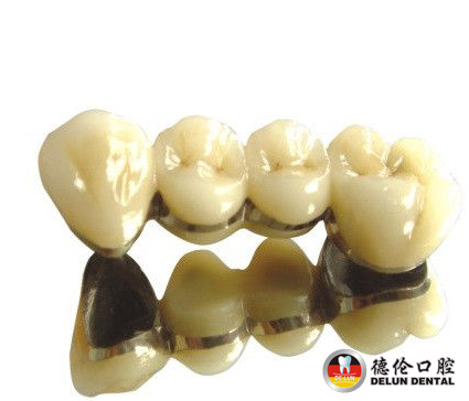 盘点十二种烤瓷牙--广州德伦口腔医院