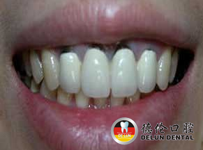 为什么烤瓷牙会过敏--广州德伦口腔医院