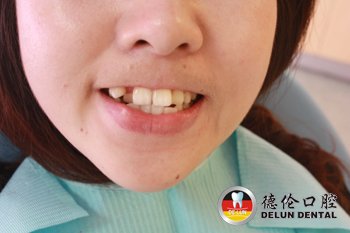 牙齿不整齐让我笑不出来--广州德伦口腔