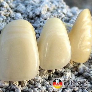 关于发达国家一般禁用镍铬烤瓷牙的硕士论文范文