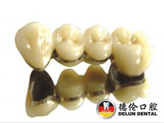 黄金烤瓷牙的优势你知道吗--广州德伦口腔