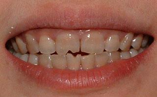 什么是中度四环素牙?--广州德伦口腔