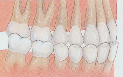 如何矫正地包天?--广州德伦口腔