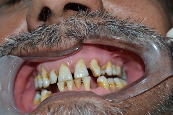 沈亦鹏医师为沙特富商美牙 仿生美容冠造就纯