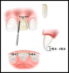 仿生氧化铝全瓷贴面介绍--广州德伦口腔