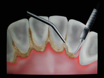 洗牙会伤害我们的牙齿吗?