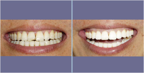 门牙断了很影响我们的形象,特别是在职场中的人,拥有微笑曲线的人