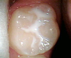 小孩牙齿上的小黑点是什么--广州德伦口腔