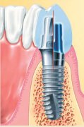 Dental Implant