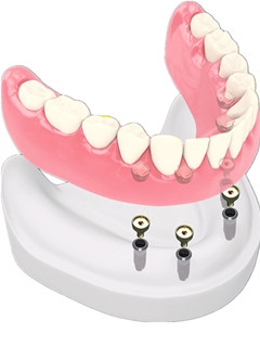 初戴活动义齿要注意哪些问题--广州德伦口腔医