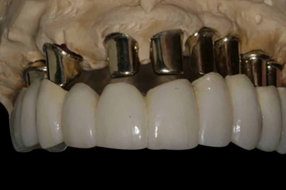 种植牙材料具有什么样的性能?--广州德伦口腔