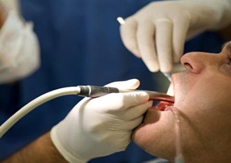 牙结石形成及治疗--广州德伦口腔