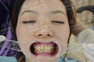 牙列拥挤、四环素牙修复--广州德伦口腔-德伦口