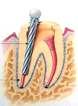 根管治疗后牙齿疼痛的原因--广州德伦口腔