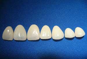 牙齿贴面有哪几种?各有什么优缺点?--广州德伦