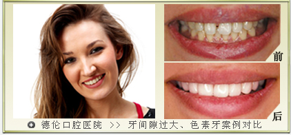 牙间隙过大,色素牙3d全瓷贴面修复案例