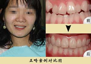 牙齿矫正对比图