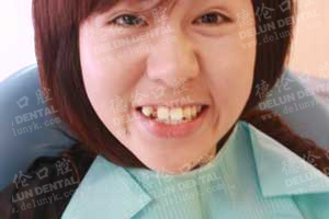 虎牙,牙列不齐矫正案例