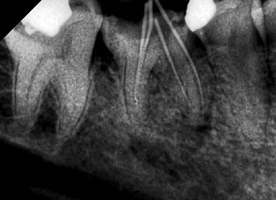 根管治疗术治疗急性牙髓炎--广州德伦口腔