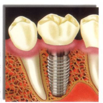如何有效地维护种植牙寿命?--广州德伦口腔