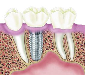 种植牙与牙龈有什么形态关系呢?--广州德伦口