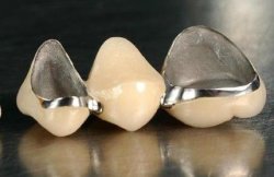 镍铬合金美容冠好不好呢?--广州德伦口腔