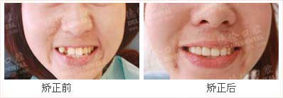 什么是虎牙?虎牙有什么危害?