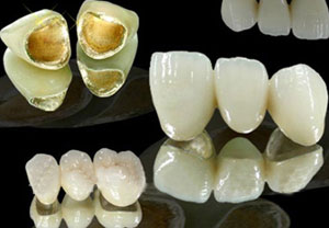 美容冠套材质有哪些?--广州德伦口腔