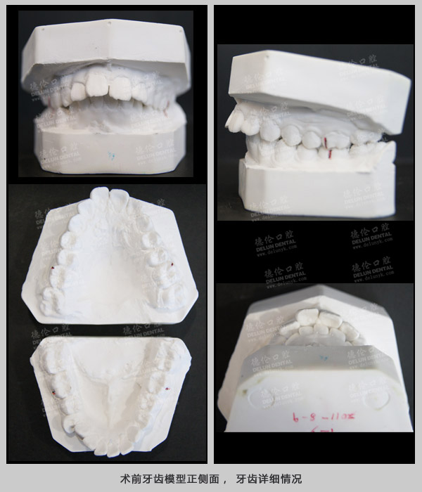 牙齿深覆合、牙齿拥挤英式矫正案例--广州德伦