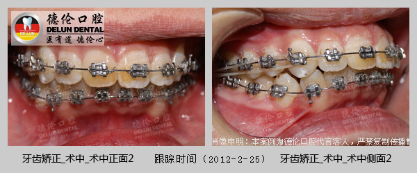 牙齿深覆合、牙齿拥挤英式矫正案例--广州德伦