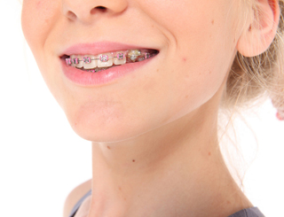 儿童牙齿矫正器有用吗?--广州德伦口腔