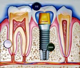 哪些因素影响种植牙使用寿命?--广州德伦口腔